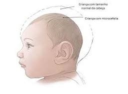 Itabuna registra seis casos de Microcefalia .
